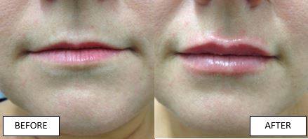 lip enhancement injections